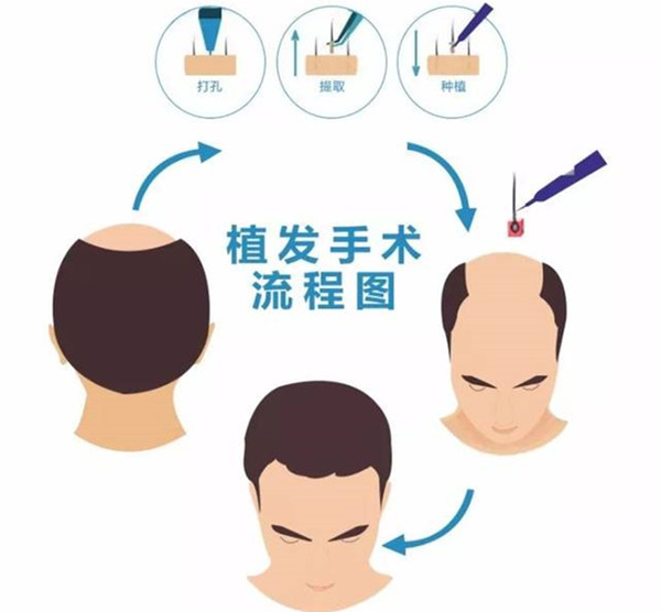 韓國毛杰琳植髮怎麼樣