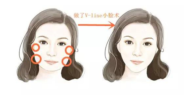 韓國輪廓手術和國內有什麼區別？對比兩者的差異再做決定