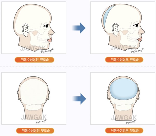 韓國延世多仁整形醫院醫生技術怎麼樣？金均泰院長下頜緣雕刻術技術超讚