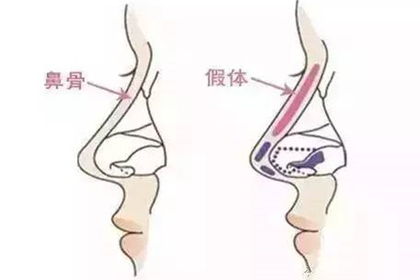 韓國整鼻子大概要多少錢？隆鼻、鼻綜合與鼻修復費用解析