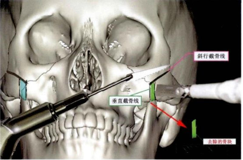 韓國輪廓整形多少錢