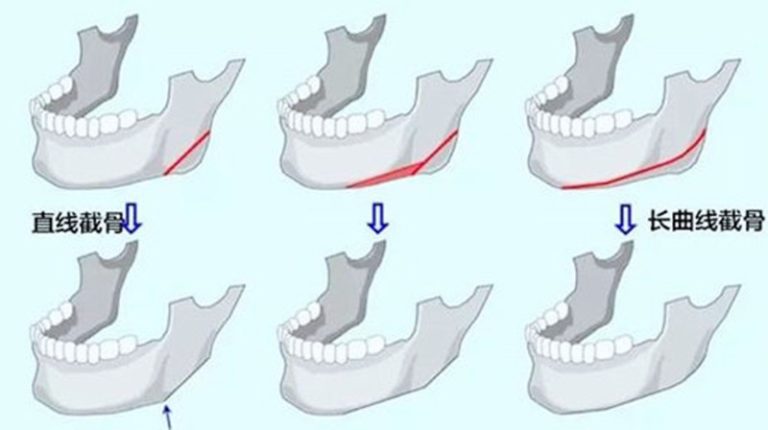 Korean Facial Bone Contouring Hospitals: Faceline, ID, and Wonjin Surgery Methods and Prices