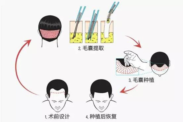 韓國植髮醫院怎麼選？首爾4家熱門植髮醫院特色整理